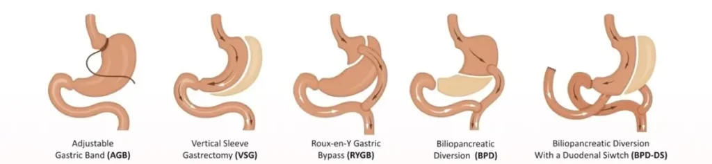 gastric bypass revision